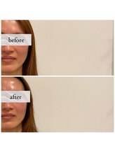 コス(KOS)/ほうれい線ビフォーアフター