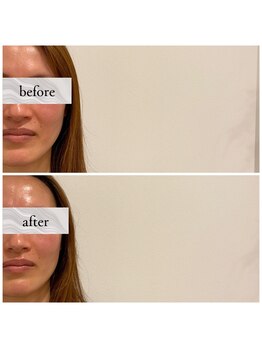 コス(KOS)/ほうれい線ビフォーアフター