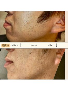 エスト(Est_.)/美容電気脱毛【毛抜き】