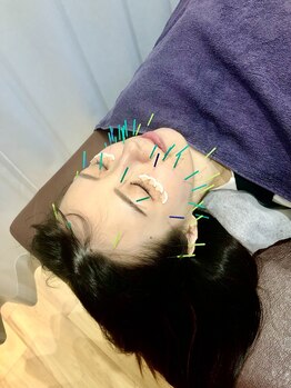 スカイ 鍼灸整骨院 整体院(SKY)/美容鍼