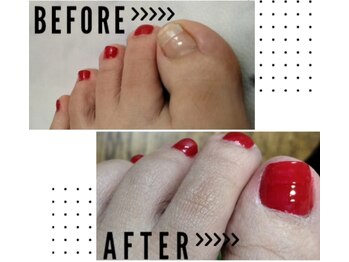 リゼランアンドコー 福島鎌田店(LIZERA&Co)/◇巻き爪矯正+ペディキュア◇