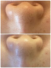 ベイビーズブレス(babys breath)/水素洗浄付き光フェイシャル☆