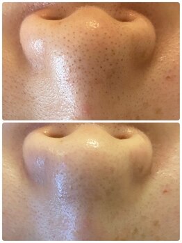 ベイビーズブレス(babys breath)/水素洗浄付き光フェイシャル☆