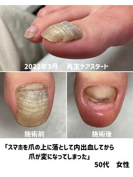 変形爪再生ケア