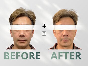 ハリット(haritt)/美容鍼B/A