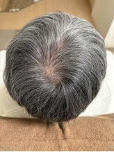 アマリージョヒラソル/Lit ヒト幹細胞エステ