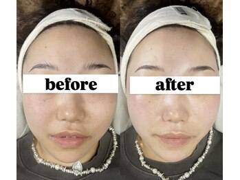 LEDエクステ専門店Fedis【マツエク/まつげパーマ/アイブロウ/フェイシャルワックス】/ツヤ肌/フェイシャルワックス