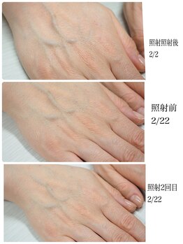 ネイル キャンバス シルヴァ(Nail Canvas Silva.)/美肌光エステの効果!