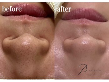 ビー エステティック(B ESTETIC)/美HANAエステ