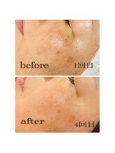 エッセンシャル アイビューティー(Essential)/プラズマシャワー Before→After