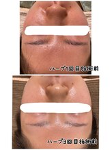 プレジール(Plaisir)/ハーブbefore★after