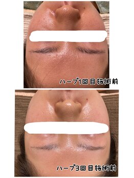 プレジール(Plaisir)/ハーブbefore★after