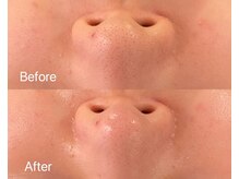 リアン(Lien)/毛穴洗浄ハイドロスプラッシュ