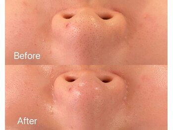 リアン(Lien)/毛穴洗浄ハイドロスプラッシュ