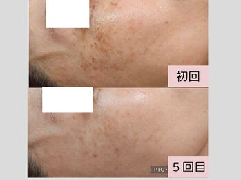 ソイ(Soi)/隠すファンデをサヨナラ！