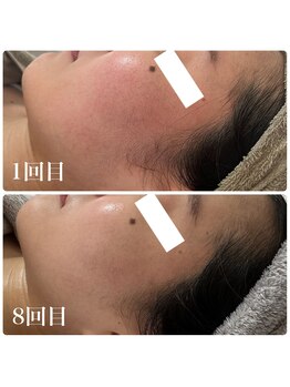 エステサロンブランシュ(Esthe salon Blanche)/ハーブピーリングで毛穴赤みケア