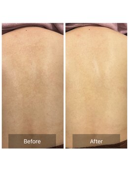 癒える(ielu)/背中★ハーブピーリング