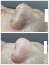 エアリアル 大川店/毛穴エクストラクション