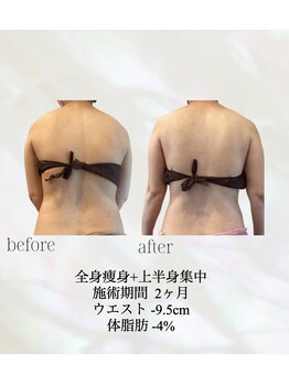 カリス(charis)/施術期間2ヶ月