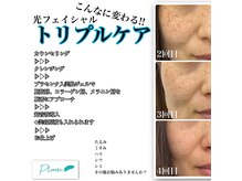 プリューム(Plume)の雰囲気（光フェイシャルの効果が凄い◎最強フェイシャルはトリプルケア☆）