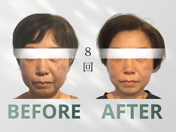 ハリット(haritt)/美容鍼B/A