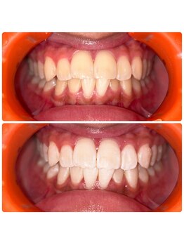 コナホワイトニング 神保町/初回ビフォア