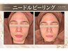 【ツヤ肌ハリUP】岩盤浴60分+ビタミンAマイクロニードル70分※要1時間前来店