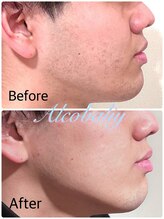 アルコバリー(Alcobaliy)/埋没毛や肌荒れも綺麗に！