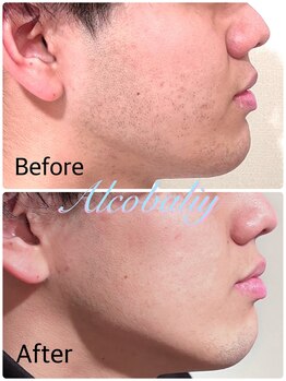 アルコバリー(Alcobaliy)/埋没毛や肌荒れも綺麗に!