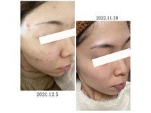 モイ(moi.)/◆日本製ピーリング◆