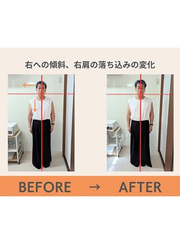 リップル オステオパシー整体院(RIPPLE)/姿勢の変化5