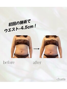 カリス(charis)/ビフォー&アフター