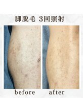 ボゴス(BOGOSS)/脚脱毛