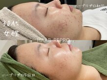 ミコサロン(miko salon)/デトックスハーブピーリング