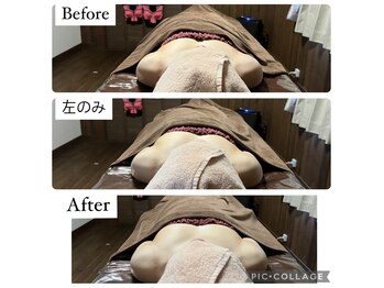 リノレア(LinoLea)/バストアップBefore after