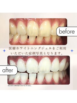 エクシアホワイトニング 麻布十番店/【歯科ホワイトニング】症例