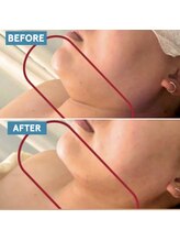 スリーアイ 天王寺店(3EYE)/脂肪分解REDショット/小顔