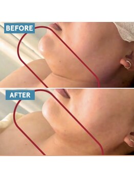 スリーアイ 天王寺店(3EYE)/脂肪分解REDショット/小顔