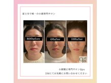 キュープ 富士店(Qpu)の雰囲気（エラボトの前にQpu富士店へご相談を！コリをほぐしてV字の輪郭へ）