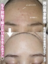 エメ(Aimer)/肌改善フェイシャル