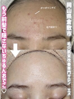 エメ(Aimer)/肌改善フェイシャル