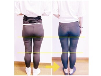 ポノフィット(PONO FIT.)/症例／ヒップ