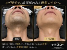 トミー(TOMMY)の雰囲気（当店の脱毛は美肌効果も◎お肌のトーンもupします♪）