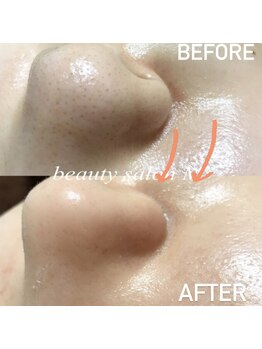 エム(M)/脱!いちご鼻・黒ずみ毛穴