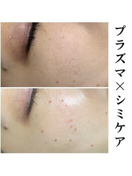 キビック(KIBIK)/【プラズマシャワー×シミケア】