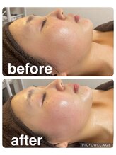 ギンザアール(GINZA R.)/スッキリ小顔に♪