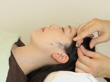 かつらはりきゅう 小児しんの雰囲気（血流を高める鍼は、幅広い症状に対応できます。ぜひご相談下さい）