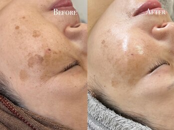 イースト(EAST)/シミプラズマフルコース10回以上