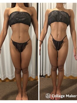 アヌヘア(Anuhea)/インディバ痩身120分 1回の施術