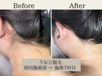 インベスト(INVEST)/うなじ脱毛